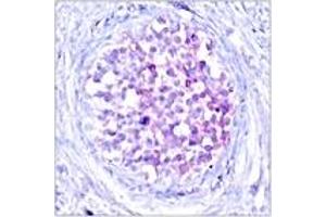 Immunohistochemistry analysis of paraffin-embedded human breast carcinoma, using C-RAF (Phospho-Ser259) Antibody.