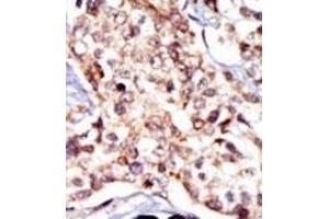 Formalin-fixed and paraffin-embedded human cancer tissue reacted with the primary antibody, which was peroxidase-conjugated to the secondary antibody, followed by DAB staining. (Src Antikörper  (N-Term))