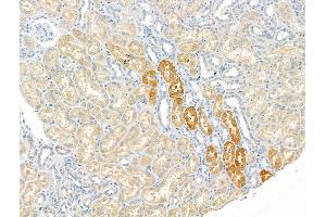 ABIN7094486 and ABIN7098535 at 1/100 staining Human kidney cancer and adjacent normal tissues by IHC-P.