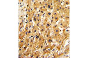 Formalin-fixed and paraffin-embedded human hepatocarcinoma with RT Antibody (N-term), which was peroxidase-conjugated to the secondary antibody, followed by DAB staining. (APRT Antikörper  (N-Term))