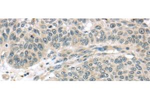 Immunohistochemistry of paraffin-embedded Human lung cancer using THAP4 Polyclonal Antibody at dilution of 1/30 (THAP4 Antikörper)