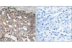 Immunohistochemistry analysis of paraffin-embedded human breast carcinoma tissue, using STMN1 (Ab-62) Antibody. (Stathmin 1 Antikörper  (AA 26-75))
