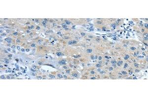 Immunohistochemistry of paraffin-embedded Human liver cancer using TNIP1 Polyclonal Antibody at dilution of 1/35