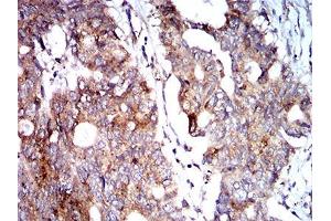Immunohistochemical analysis of paraffin-embedded rectum cancer tissues using BNIP3 mouse mAb with DAB staining. (BNIP3 Antikörper  (AA 50-155))