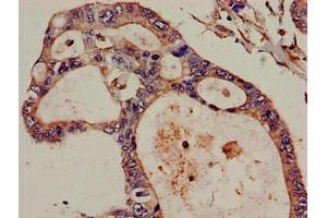 Immunohistochemistry of paraffin-embedded human pancreatic cancer using ABIN7152297 at dilution of 1:100 (DIS3 Antikörper  (AA 30-187))