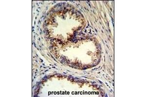 Formalin-fixed and paraffin-embedded human prostate carcinoma reacted with GOLPH3 Antibody (N-term), which was peroxidase-conjugated to the secondary antibody, followed by DAB staining. (GOLPH3 Antikörper  (N-Term))