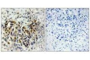 Immunohistochemistry analysis of paraffin-embedded human breast carcinoma tissue, using IRX3 antibody. (IRX3 Antikörper)