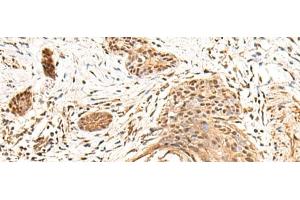 Immunohistochemistry of paraffin-embedded Human esophagus cancer tissue using KCTD13 Polyclonal Antibody at dilution of 1:55(x200)
