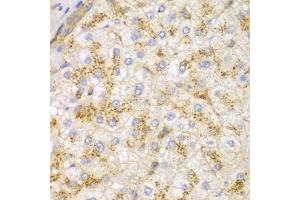 Immunohistochemistry of paraffin-embedded human liver cancer using ACTN1 antibody. (ACTN1 Antikörper)