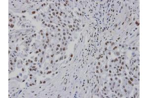 IHC-P Image Immunohistochemical analysis of paraffin-embedded human lung cancer patient tumor, using RPA 14 kDa subunit , antibody at 1:100 dilution.