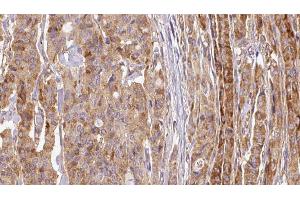 ABIN6267114 at 1/100 staining Human thyroid cancer tissue by IHC-P.
