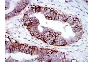 Immunohistochemical analysis of paraffin-embedded ovarian cancer tissues using IGF1R-Beta mouse mAb with DAB staining.
