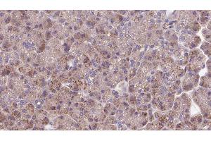 ABIN6273280 at 1/100 staining Human pancreas cancer tissue by IHC-P.