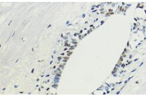Immunohistochemistry of paraffin-embedded Human breast using TriMethyl-Histone H3-K36 Polyclonal Antibody at dilution of 1:200 (40x lens).