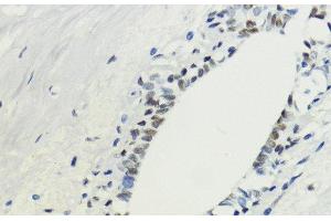 Immunohistochemistry of paraffin-embedded Human breast using TriMethyl-Histone H3-K36 Polyclonal Antibody at dilution of 1:200 (40x lens). (Histone 3 Antikörper  (3meLys36))