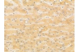 ABIN7097165 and ABIN7101233 at 1/100 staining human hepatocellular carcinoma by IHC-P.