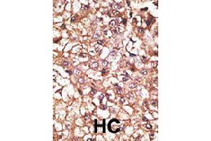 Formalin-fixed and paraffin-embedded human hepatocellular carcinoma tissue reacted with STUB1 polyclonal antibody  , which was peroxidase-conjugated to the secondary antibody, followed by AEC staining. (STUB1 Antikörper  (AA 160-190))