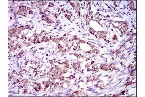 Immunohistochemical analysis of paraffin-embedded cervical cancer tissues using DNAL4 mouse mAb with DAB staining. (DNAL4 Antikörper  (AA 1-105))