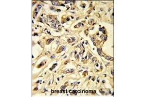 Formalin-fixed and paraffin-embedded human breast carcinoma reacted with VGFR1 Antibody, which was peroxidase-conjugated to the secondary antibody, followed by DAB staining. (FLT1 Antikörper)