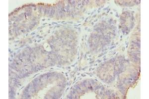 Immunohistochemistry of paraffin-embedded human endometrial cancer using ABIN7159191 at dilution of 1:100 (MND1 Antikörper  (AA 2-205))