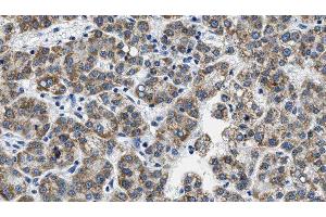 ABIN6276063 at 1/100 staining Human liver cancer tissue by IHC-P. (NPY5R Antikörper  (Internal Region))
