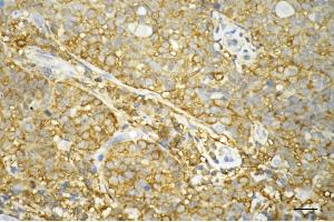 Immunohistochemistry was performed on paraffin-embedded human breast carcinoma using STAT1 antibody (ABIN7800336), 1:200). (Rekombinanter STAT1 Antikörper)