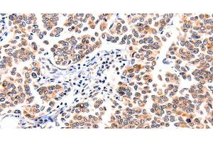 Immunohistochemistry of paraffin-embedded Human breast cancer using GNRHR Polyclonal Antibody at dilution of 1:117