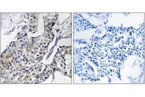 Immunohistochemistry analysis of paraffin-embedded human breast carcinoma, using GBP4 Antibody.
