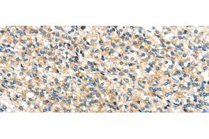 Immunohistochemistry of paraffin-embedded Human prostate cancer tissue using TTI1 Polyclonal Antibody at dilution 1:40