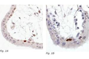 Immunohistochemistry (IHC) image for anti-Tumor Protein P53 (TP53) (AA 378-393), (C-Term), (pSer392) antibody (ABIN238404) (p53 Antikörper  (C-Term, pSer392))