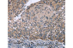 Immunohistochemistry of Human cervical cancer using RNF144B Polyclonal Antibody at dilution of 1:50 (RNF144B Antikörper)