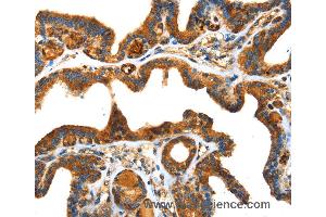 Immunohistochemistry of Human thyroid cancer using SPARC Polyclonal Antibody at dilution of 1:25 (SPARC Antikörper)