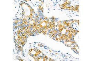 Immunohistochemistry of paraffin embedded human breast cancer using Epl4 (ABIN7073843) at dilution of 1:2000 (400x lens) (EFNA4 Antikörper)