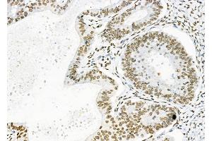 ABIN6261287 and ABIN6279346 at 1/100 staining human ovarian cancer by IHC-P. (DHRS1 Antikörper  (Internal Region))