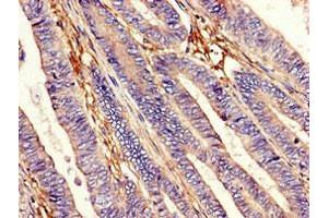 Immunohistochemistry of paraffin-embedded human colon cancer using ABIN7151326 at dilution of 1:100