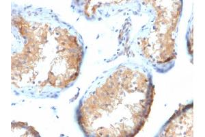 Formalin-fixed, paraffin-embedded human Testicular Carcinoma stained with Vinculin Mouse Monoclonal Antibody (VCL/2573). (Vinculin Antikörper  (AA 174-322))
