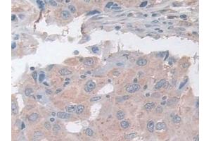 Detection of ASAH1 in Human Breast cancer Tissue using Polyclonal Antibody to N-Acylsphingosine Amidohydrolase 1 (ASAH1) (ASAH1 Antikörper  (AA 144-395))