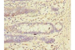 Immunohistochemistry of paraffin-embedded human colon cancer using ABIN7151244 at dilution of 1:100 (TRIM17 / RNF16 Antikörper  (AA 1-300))
