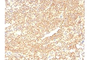 Formalin-fixed, paraffin-embedded human Mantle Cell Lymphoma stained with Cyclin D1 Mouse Monoclonal Antibody (CCND1/2593). (Cyclin D1 Antikörper)