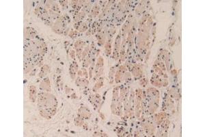 IHC-P analysis of Human Esophagus Cancer Tissue, with DAB staining. (Caspase 3 Antikörper  (AA 29-175))