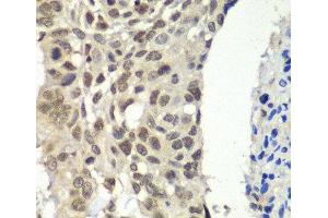 Immunohistochemistry of paraffin-embedded Human esophageal cancer using SSRP1 Polyclonal Antibody at dilution of 1:100 (40x lens). (SSRP1 Antikörper)