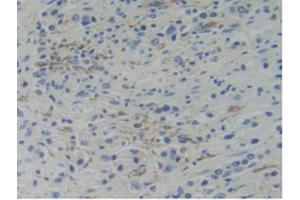 IHC-P analysis of Human Prostate Gland Cancer Tissue, with DAB staining. (WARS Antikörper  (AA 247-458))