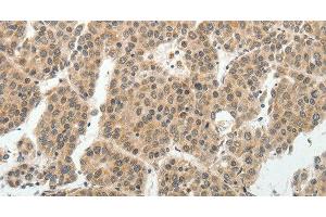 Immunohistochemistry of paraffin-embedded Human liver cancer tissue using SOCS7 Polyclonal Antibody at dilution 1:30 (SOCS7 Antikörper)
