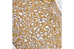 Immunohistochemistry of paraffin-embedded Human esophageal cancer using Cytokeratin 19 (KRT19) antibody (ABIN7268099) at dilution of 1:100 (40x lens). (Cytokeratin 19 Antikörper)