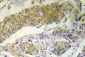 Immunohistochemistry (IHC) analyzes of p-BAD antibody in paraffin embedded human breast carcinoma tissue. (BAD Antikörper  (pSer112))