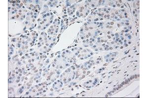 Immunohistochemical staining of paraffin-embedded Adenocarcinoma of breast tissue using anti-VEGF mouse monoclonal antibody. (VEGF Antikörper  (AA 27-233))