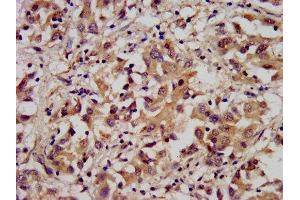 IHC image of ABIN7143473 diluted at 1:300 and staining in paraffin-embedded human liver cancer performed on a Leica BondTM system. (ARL1 Antikörper  (AA 2-181))