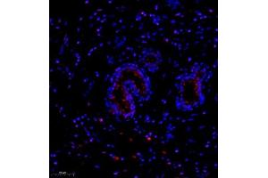 Immunofluorescence of paraffin embedded human breast cancer using NCK (ABIN7074783) at dilution of 1:1000 (250x lens) (NCK2 Antikörper)