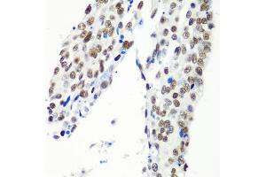 Immunohistochemistry of paraffin-embedded human lung cancer using HTATSF1 antibody (ABIN5973562) at dilution of 1/100 (40x lens). (HTATSF1 Antikörper)