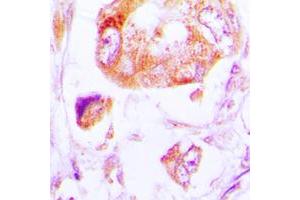 Immunohistochemical analysis of CK1 alpha staining in human lung cancer formalin fixed paraffin embedded tissue section. (CSNK1A1 Antikörper  (Center))